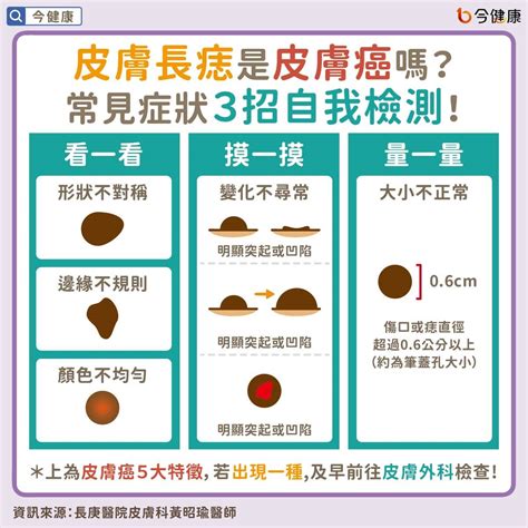 手臂長痣|皮膚長痣是皮膚癌嗎？常見症狀，簡單3招自我檢測｜ 